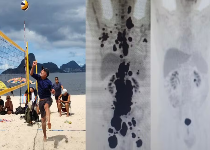 Paciente tratado com terapia oferecida pelo SUS completa um ano de remissão da doença