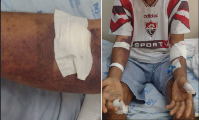 Casa Nova (BA): Homem é picado por jararaca e é socorrido para o hospital