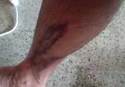 Estudante atacado por cães na UFRPE em Serra Talhada (PE) recebe indenização de R$ 10 mil. Estudante atacado por cães na UFRPE em Serra Talhada (PE) recebe indenização de R$ 10 mil.