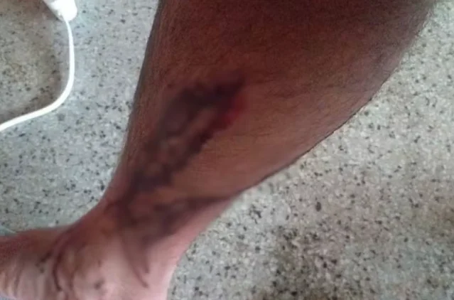 Estudante atacado por cães na UFRPE em Serra Talhada (PE) recebe indenização de R$ 10 mil.