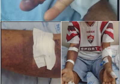 Homem sofre picada de jararaca e é levado para o hospital na zona rural de Casa Nova