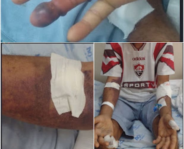 Homem sofre picada de jararaca e é levado para o hospital na zona rural de Casa Nova